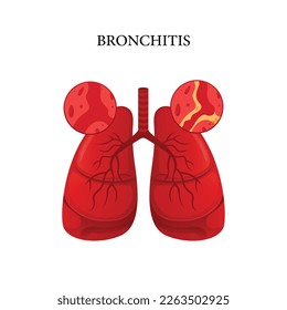 Bronchitis-Krankheitsvektor, Illustrationsdesign für die Medizin