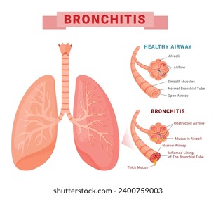 Bronchitis and healthy airway structure infographic medical education scheme banner isometric vector illustration. Normal and unwell bronchial tube anatomical inflammation respiration health care