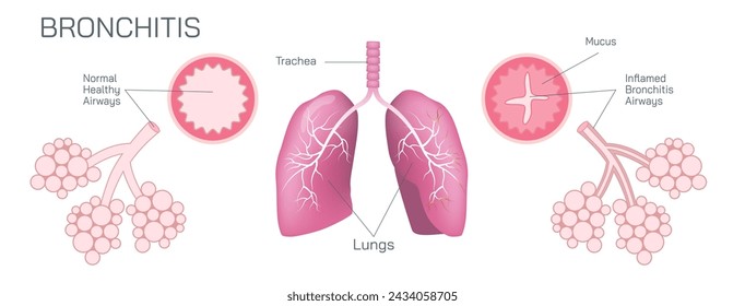 La bronquitis es una inflamación de los bronquios, que son los conductos de aire que transportan el aire a los pulmones. Puede ser una ilustración vectorial aguda o crónica