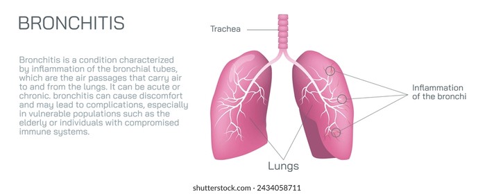 Bronchitis is an inflammation of the bronchial tubes, which are the air passages that carry air to the lungs. It can be either acute or chronic vector illustration