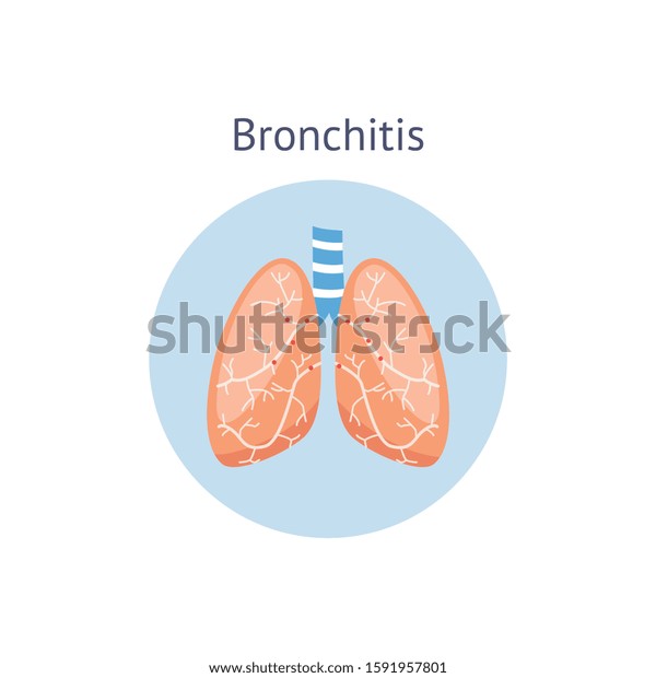 Bronchitis Lung Disease Illness Medical Anatomical Stock Vector ...