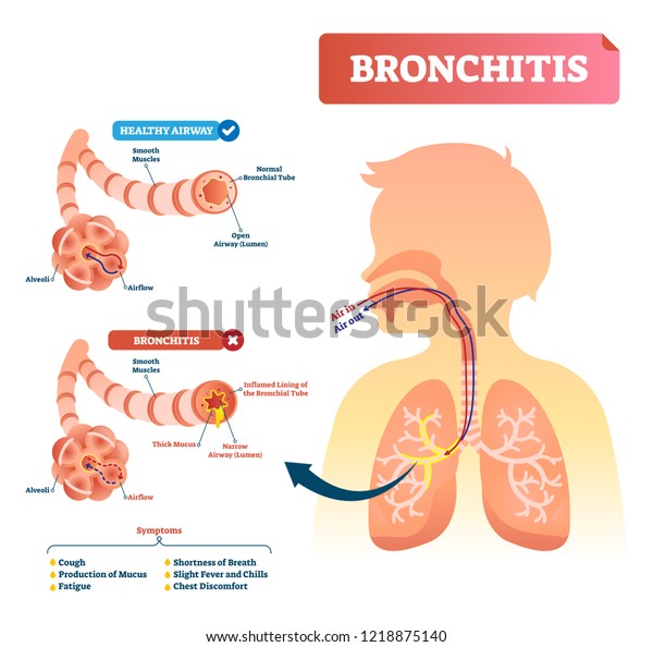 Bronchitis Vector Illustration Lung Disease Diagnosis ...