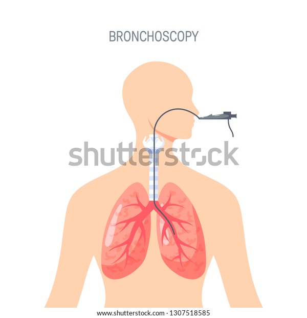 気管支鏡 肺診断コンセプト フラットスタイルのベクターイラスト ウェブバナー 広告 ポスター インフォグラフィックス用のテンプレート のベクター画像素材 ロイヤリティフリー