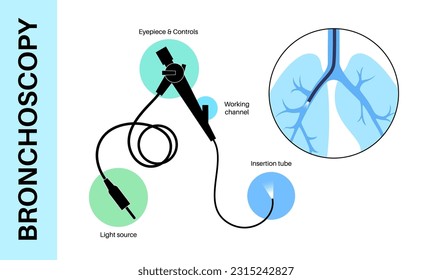 Bronchoscopy procedure. Pulmonologist uses a bronchoscope through trachea into the lung. Respiratory system diseases and treatment. Endobronchial ultrasound bronchoscopy diagnostic vector illustration
