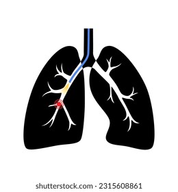 Bronchoscopy procedure. Pulmonologist uses a bronchoscope through trachea into the lung. Respiratory system diseases and treatment. Endobronchial ultrasound bronchoscopy diagnostic vector illustration