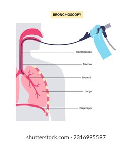 Bronchoscopy procedure. Pulmonologist uses a bronchoscope through mouth into the lung. Respiratory system diseases and treatment. Endobronchial ultrasound bronchoscopy diagnostic vector illustration.