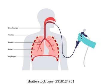 Bronchoscopy procedure. Pulmonologist uses a bronchoscope through mouth into the lung. Respiratory system diseases and treatment. Endobronchial ultrasound bronchoscopy diagnostic vector illustration.
