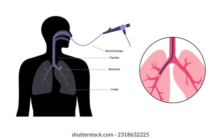 Bronchoscopy procedure. Pulmonologist uses a bronchoscope through mouth into the lung. Respiratory system diseases and treatment. Endobronchial ultrasound bronchoscopy diagnostic vector illustration.