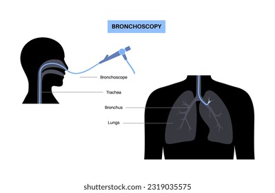 Bronchoscopy procedure. Pulmonologist uses a bronchoscope through mouth into the lung. Respiratory system diseases and treatment. Endobronchial ultrasound bronchoscopy diagnostic vector illustration.