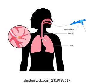 Bronchoscopy procedure. Pulmonologist uses a bronchoscope through mouth into the lung. Respiratory system diseases and treatment. Endobronchial ultrasound bronchoscopy diagnostic vector illustration.