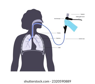 Bronchoscopy procedure. Pulmonologist uses a bronchoscope through mouth into the lung. Respiratory system diseases and treatment. Endobronchial ultrasound bronchoscopy diagnostic vector illustration.