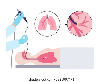 Bronchoscopy procedure. Pulmonologist uses a bronchoscope through mouth into the lung. Respiratory system diseases and treatment. Endobronchial ultrasound bronchoscopy diagnostic vector illustration.