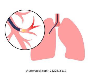 Procedimiento de broncocopia. El pulmonólogo utiliza un broncooscopio a través de la traquea al pulmón. Enfermedades del sistema respiratorio y tratamiento. Ilustración del vector de diagnóstico por ecografía endobronquial