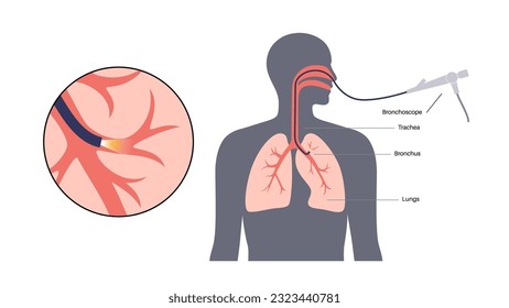 Bronchoscopy procedure. Pulmonologist uses a bronchoscope through mouth into the lung. Respiratory system diseases and treatment. Endobronchial ultrasound bronchoscopy diagnostic vector illustration.