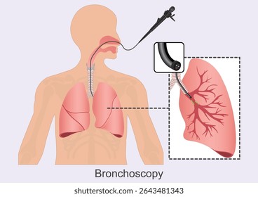 Bronchoscopy is a procedure that lets doctors look at lungs and air passages. Medical Healthcare, vector illustration.