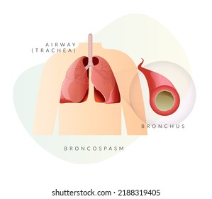 Bronchospasm - Blocked Airway In Human Lungs -  Inflamed Airway  - Illustration As EPS 10 File