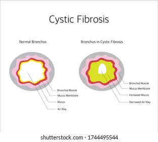 Bronchus in Cystic Fibrosis 
Vector Diagram. Both normal bronchus and bronchus in cystic fibrosis are explained.