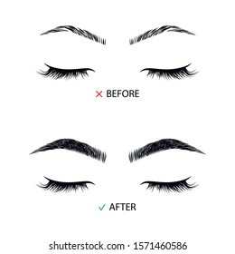 Brow correction before and after illustration