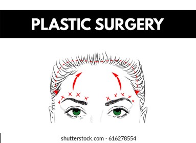 Brow Lift. Plastic Surgery. Cosmetic Surgery. Vector Illustration. 