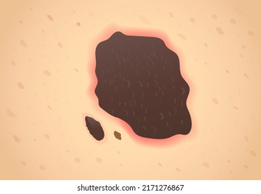 Brown Spot Lesion That Starts Skin Cancer Disease. Close Up Illustration For Diagnosis And Classification