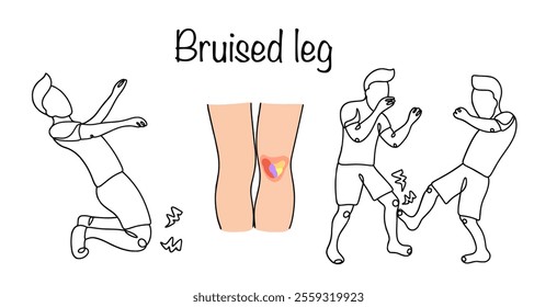 Bruised leg. Closed injury of superficial soft tissue formations of the knee joint. Knee injury due to a fall or blow. A man gets a bruised knee and a bruise on his leg. Hand drawn line illustration.