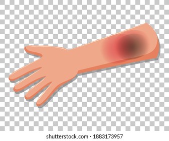 Bruised skin on an arm isolated on transparent background illustration