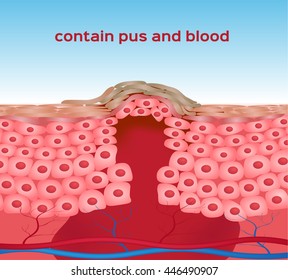 bruised , wound skin vector graphic . the blood almost come out of it , bleeding