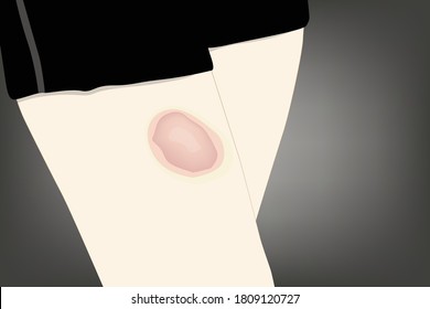 Las hematomas son causadas por las baches