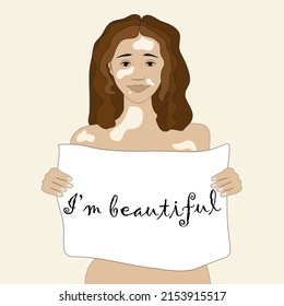 A brunette girl with vitiligo smiles and holds a poster with the inscription "I am beautiful", non-standard beauty