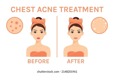 Brunette Woman with Problem Skin on Chest. Before and After. Red Pimples and Acne Rash. Treatment of Skin of Decollete. Color Cartoon style. White background. Vector illustration for Medical design.