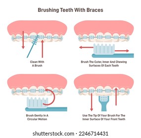 Brushing teeth with braces system. Oral care with special brush. Orthodontics educational poster. Flat vector illustration