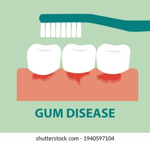 Brushing teeth to prevent gum disease