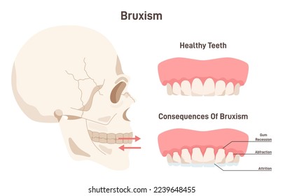 Bruxism. Condition in which person grind, gnash or clench your teeth. Dentistry health problem. Dental care, dentistry infographic banner or poster. Flat vector illustration