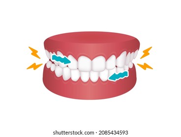 Bruxism vector illustration | grinding teeth