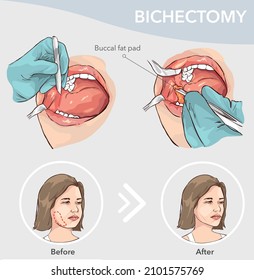 Buccal Fat Pad Removal  Before and after vector illustration