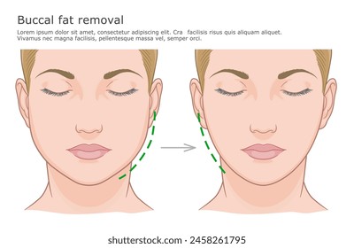 Buccal fat removal surgery illustration. Before and after. Plastic surgery medical illustration.