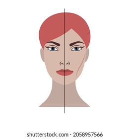 Buccal Fat Removal. Vector illustration