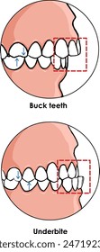 Bucco-version tooth an outward positioning of the teeth projecting teeth

