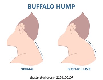 buffalo dowager's hump head bad poor women spine pad excess shape High level tumor cysts side effect body bone long term use curved muscle surgical diet Back sign