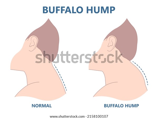 buffalo dowager's hump head bad
poor women spine pad excess shape High level tumor cysts side
effect body bone long term use curved muscle surgical diet Back
sign