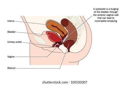 Bulging Of The Bladder Wall Into The Anterior Vaginal Wall, Forming A Cystocele And Causing Urinary Retention