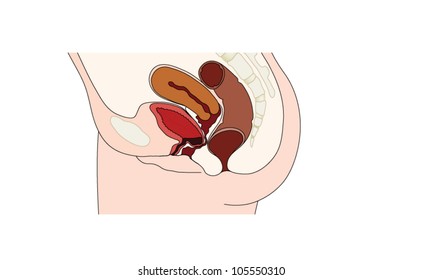 Bulging Of The Bladder Wall Into The Anterior Vaginal Wall, Forming A Cystocele And Causing Urinary Retention