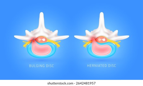 Disco em abaulamento e disco herniado. A compressão do nervo causa dor nas costas e no pescoço. Exemplos de degeneração de disco. Espinal com medula nervosa amarela. Órgão ósseo vertebral. Conceito de diagnóstico médico. Vetor.