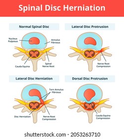 Bulging Disc and Herniated Disc. Stages of Spinal Disc extrusion. Simple Hernia graphic illustration in flat cartoon style. 