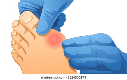 Golpear en la pierna. Pie con gota. Hallux valgus. Ilustración sanitaria. Ilustración del vector