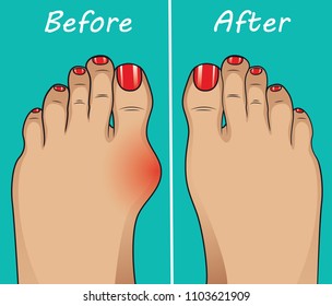 Bunion before and after operation. Vector illustration.