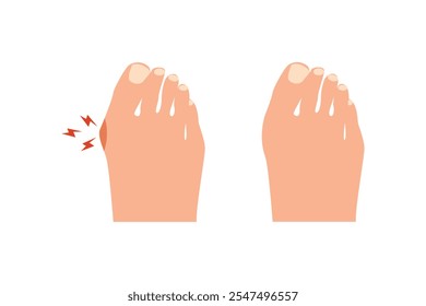 Bunion before and after operation. Vector illustration.