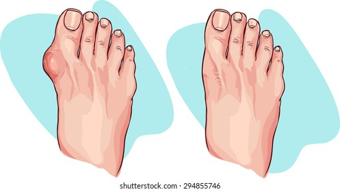 Bunion before and after operation. Vector illustration.