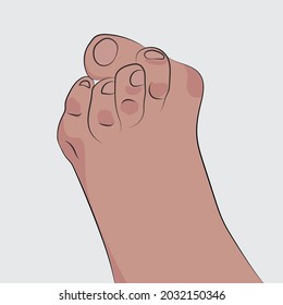 Bunion, a bony lump that forms at the joint at the base of the big toe. Vector diseases.