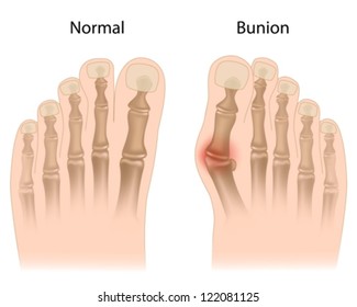 Bunion In Foot